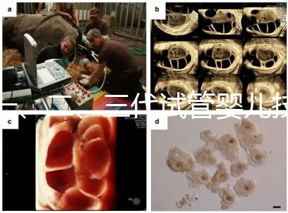 一、二、三代試管嬰兒技術的區別，看完你就知道了！