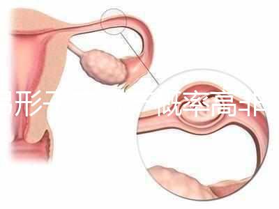 弓形子宮流產概率高非個例！罪魁禍首是這個原因