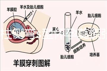 脊柱側彎s型懷孕莫慌張,能否順產(chǎn)還得看這4大要素