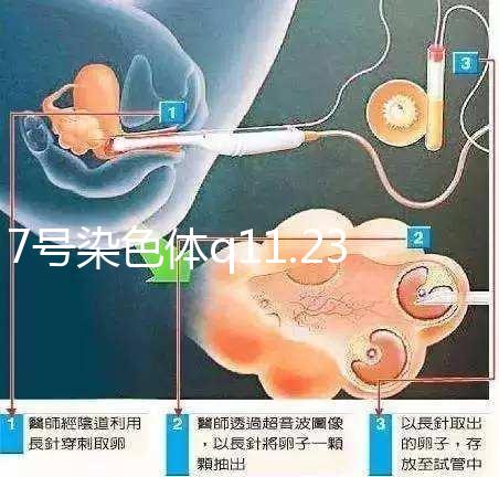 7號染色體q11.23重復綜合征患者智力水平低下，能治療嗎？