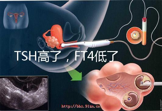 TSH高了，F(xiàn)T4低了，需要補碘嗎？